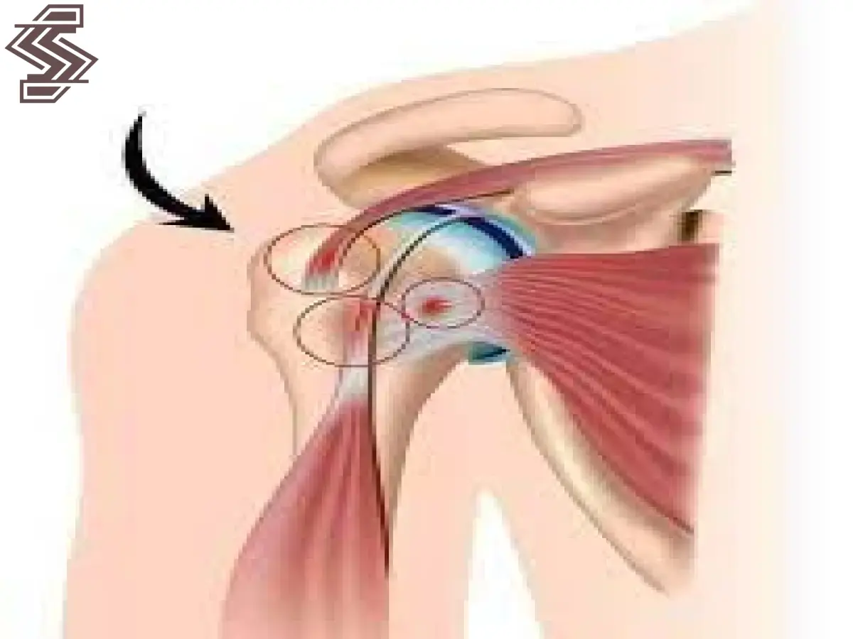 ترميم اوتار الكتف