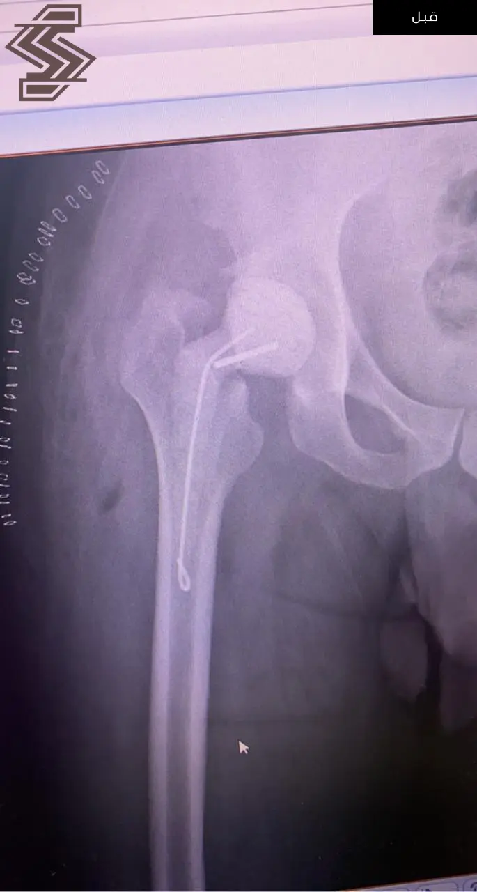 استبدال مفصل معقد نتيجة التهاب في مفصل الورك