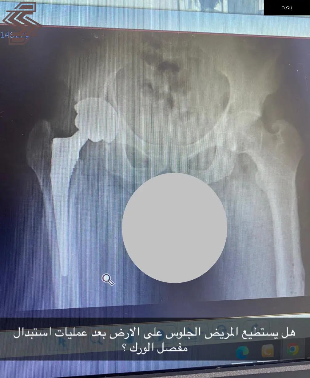 استبدال مفصل معقد نتيجة التهاب في مفصل الورك
